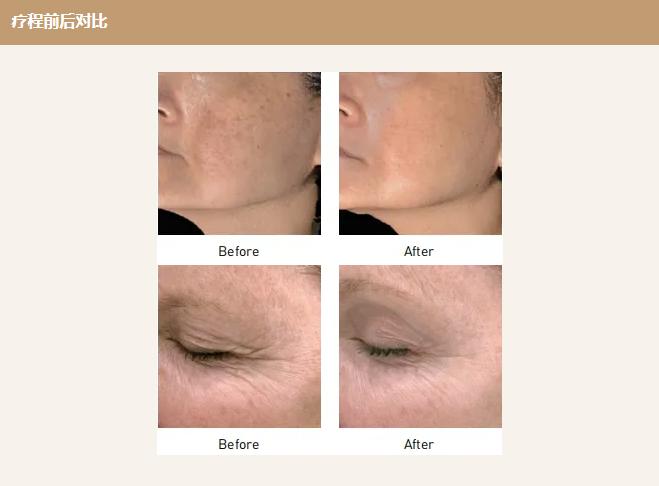 去韓國做黃金微針多少錢？首爾探店真實物價，不看怕你被宰插图7